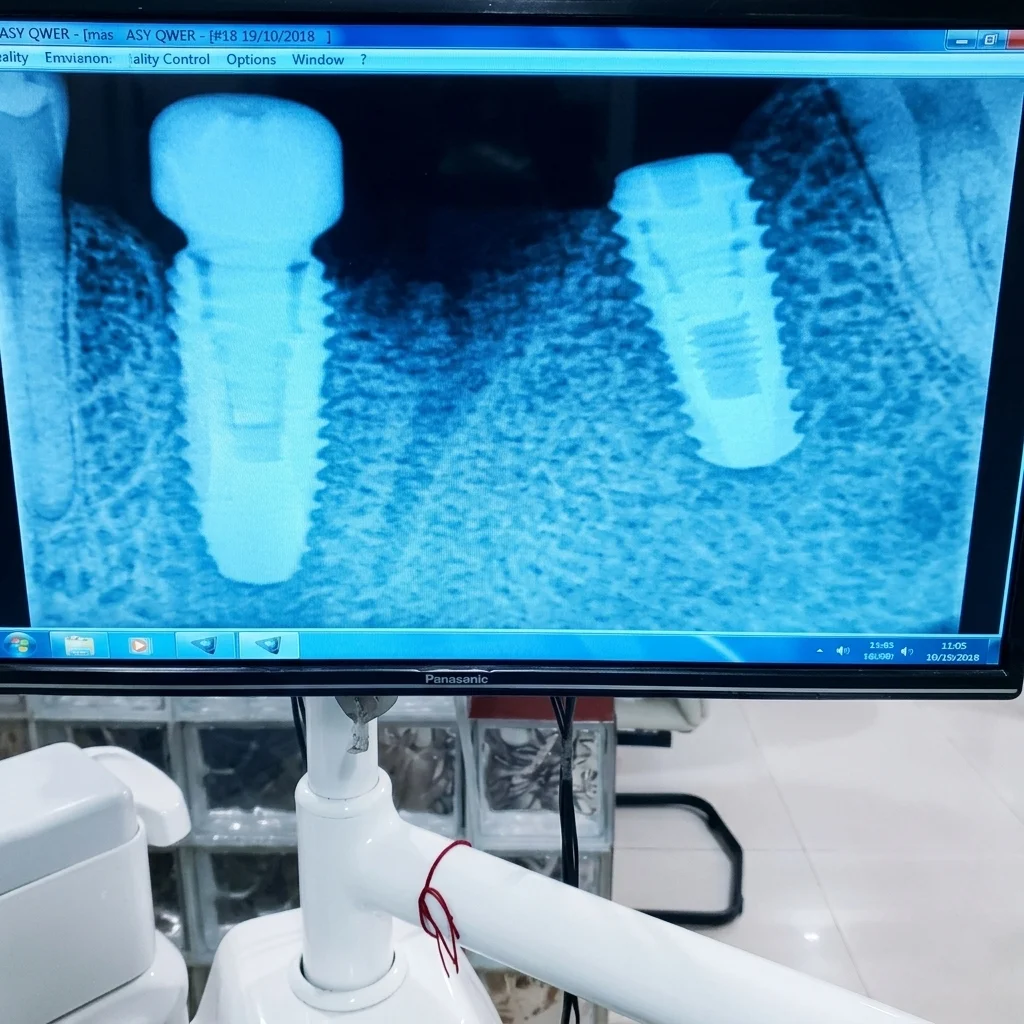 Dental Implant Fixed